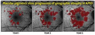 Macular Pigment